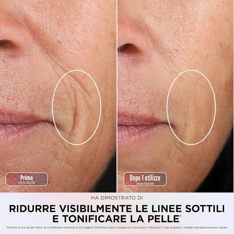 Prima e dopo trattamento viso LED per linee sottili e pelle.